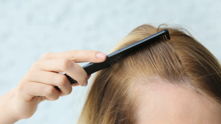 Hair Loss Dermatologist in Ellicott City, Maryland for Alopecia Areata